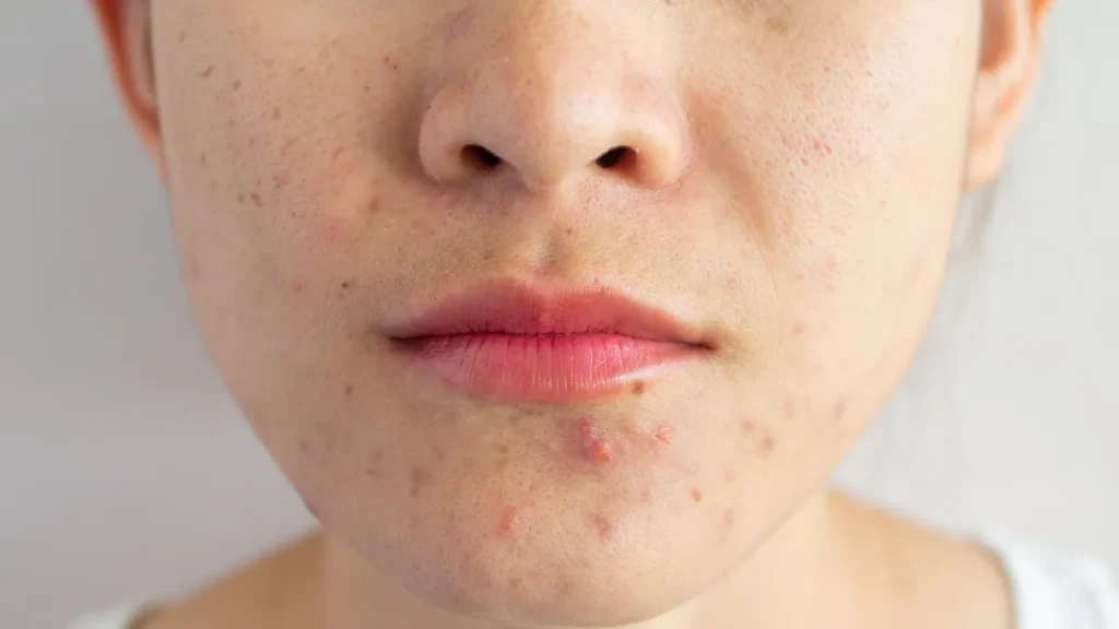 Get rid of acne