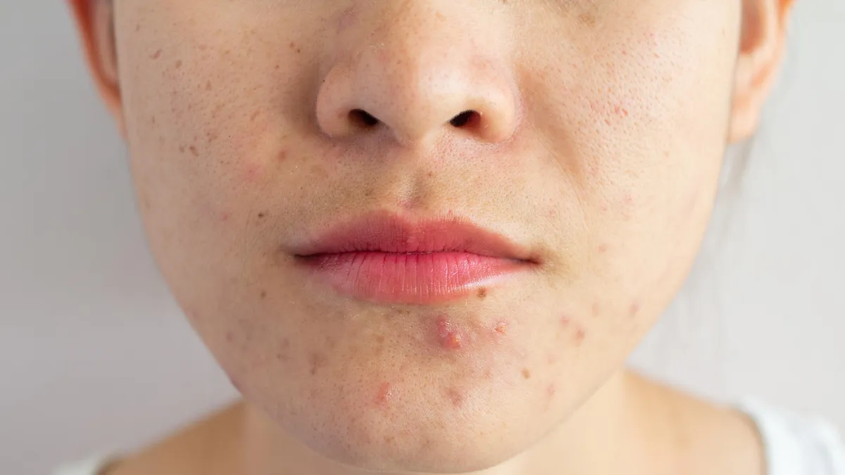 How to Get Rid of Acne Naturally